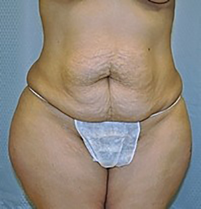 tummy-tuck-cosmetic-surgery-abdominoplasty-beverly-hills-woman-before-front-dr-maan-kattash