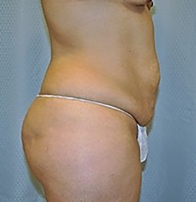 tummy-tuck-cosmetic-surgery-abdominoplasty-beverly-hills-woman-before-side-dr-maan-kattash