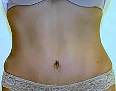 tummy-tuck-cosmetic-surgery-abdominoplasty-claremont-woman-after-front-dr-maan-kattash