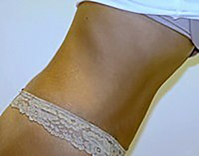 tummy-tuck-cosmetic-surgery-abdominoplasty-claremont-woman-after-side-dr-maan-kattash