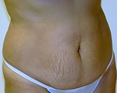 tummy-tuck-cosmetic-surgery-abdominoplasty-claremont-woman-before-oblique-dr-maan-kattash