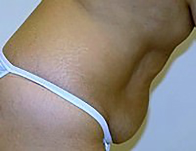 tummy-tuck-cosmetic-surgery-abdominoplasty-claremont-woman-before-side-dr-maan-kattash