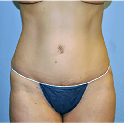 tummy-tuck-cosmetic-surgery-abdominoplasty-los-angeles-woman-after-front-dr-maan-kattash