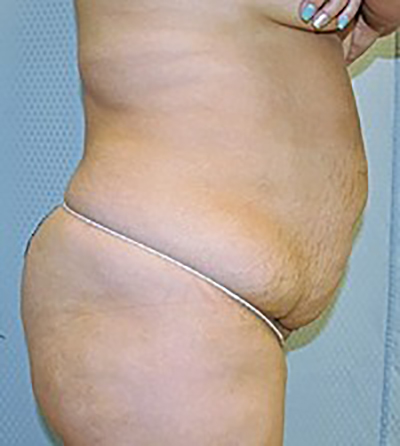 tummy-tuck-cosmetic-surgery-abdominoplasty-rancho-cucamonga-woman-before-side-dr-maan-kattash