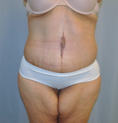 tummy-tuck-cosmetic-surgery-abdominoplasty-redlands-woman-after-front-dr-maan-kattash