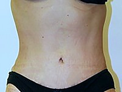 tummy-tuck-cosmetic-surgery-abdominoplasty-upland-woman-after-front-dr-maan-kattash