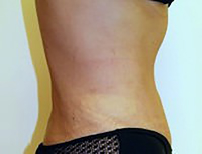 tummy-tuck-cosmetic-surgery-abdominoplasty-upland-woman-after-side-dr-maan-kattash
