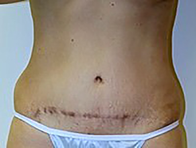 tummy-tuck-cosmetic-surgery-abdominoplasty-upland-woman-before-front-dr-maan-kattash