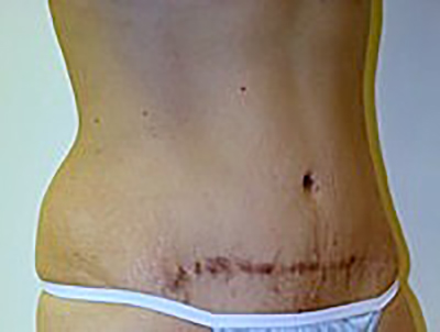 tummy-tuck-cosmetic-surgery-abdominoplasty-upland-woman-before-oblique-dr-maan-kattash