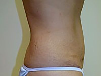 tummy-tuck-cosmetic-surgery-abdominoplasty-upland-woman-before-side-dr-maan-kattash