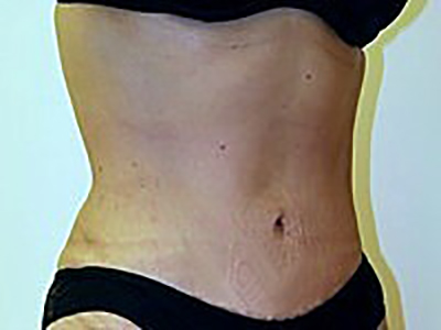 tummy-tuck-cosmetic-surgery-abdominoplasty-upland-woman-oblique-front-dr-maan-kattash