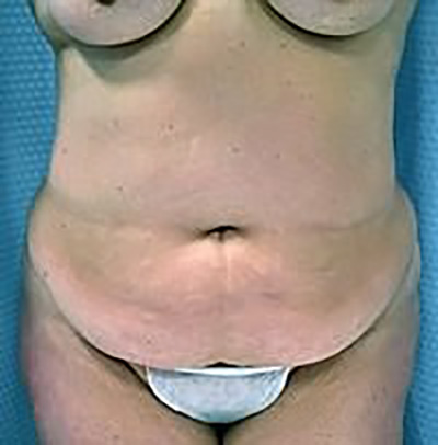 tummy-tuck-plastic-surgery-abdominoplasty-loose-skin-beverly-hills-woman-before-front-dr-maan-kattash