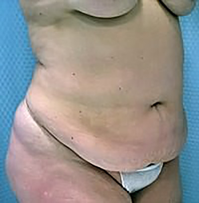 tummy-tuck-plastic-surgery-abdominoplasty-loose-skin-beverly-hills-woman-before-oblique-dr-maan-kattash