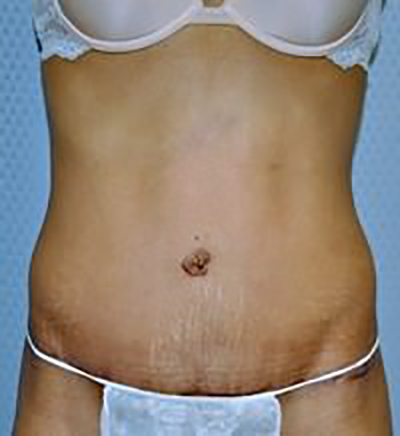 tummy-tuck-plastic-surgery-abdominoplasty-loose-skin-claremont-after-front-dr-maan-kattash