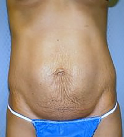 tummy-tuck-plastic-surgery-abdominoplasty-loose-skin-claremont-woman-before-front-dr-maan-kattash