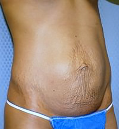 tummy-tuck-plastic-surgery-abdominoplasty-loose-skin-claremont-woman-before-oblique-dr-maan-kattash