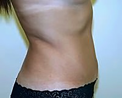 tummy-tuck-plastic-surgery-abdominoplasty-loose-skin-irvine-after-side-dr-maan-kattash