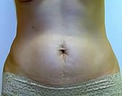 tummy-tuck-plastic-surgery-abdominoplasty-loose-skin-irvine-woman-before-front-dr-maan-kattash