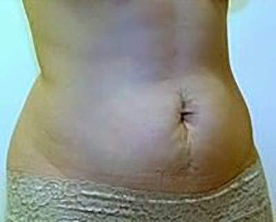 tummy-tuck-plastic-surgery-abdominoplasty-loose-skin-irvine-woman-before-oblique-dr-maan-kattash