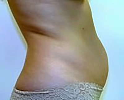 tummy-tuck-plastic-surgery-abdominoplasty-loose-skin-irvine-woman-before-side-dr-maan-kattash
