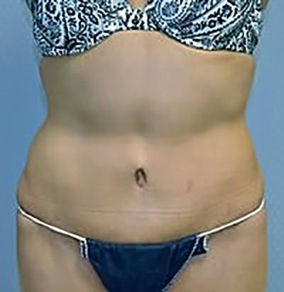 tummy-tuck-plastic-surgery-abdominoplasty-loose-skin-los-angeles-woman-after-front-dr-maan-kattash