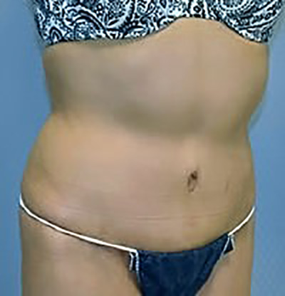 tummy-tuck-plastic-surgery-abdominoplasty-loose-skin-los-angeles-woman-after-oblique-dr-maan-kattash