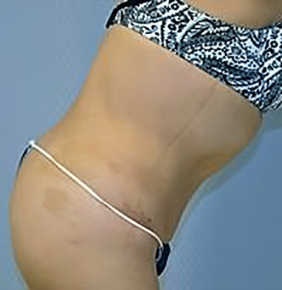 tummy-tuck-plastic-surgery-abdominoplasty-loose-skin-los-angeles-woman-after-side-dr-maan-kattash