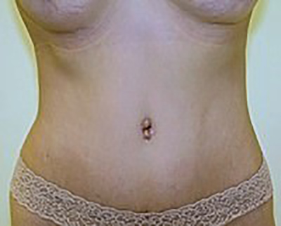 tummy-tuck-plastic-surgery-abdominoplasty-loose-skin-orange-county-after-front-dr-maan-kattash