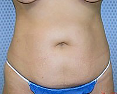 tummy-tuck-plastic-surgery-abdominoplasty-loose-skin-orange-county-woman-before-front-dr-maan-kattash