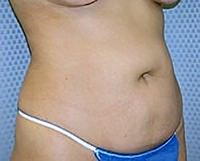 tummy-tuck-plastic-surgery-abdominoplasty-loose-skin-orange-county-woman-before-oblique-dr-maan-kattash