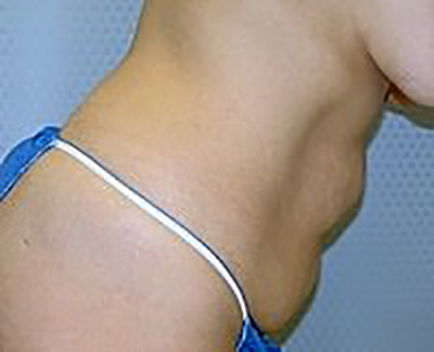 tummy-tuck-plastic-surgery-abdominoplasty-loose-skin-orange-county-woman-before-side-dr-maan-kattash