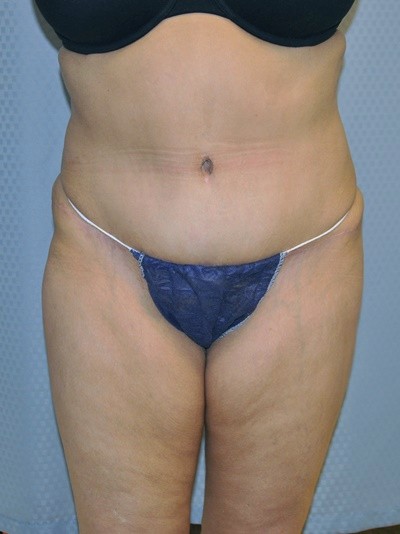 tummy-tuck-plastic-surgery-abdominoplasty-loose-skin-redlands-after-front-dr-maan-kattash