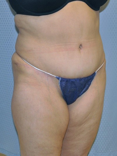 tummy-tuck-plastic-surgery-abdominoplasty-loose-skin-redlands-after-oblique-dr-maan-kattash