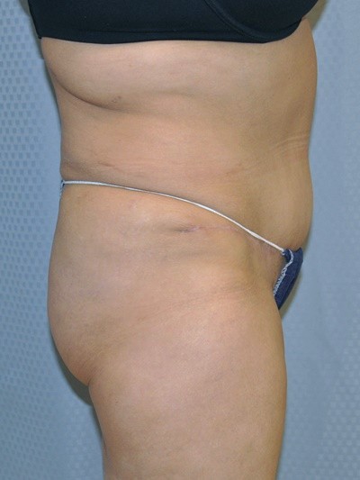 tummy-tuck-plastic-surgery-abdominoplasty-loose-skin-redlands-after-side-dr-maan-kattash