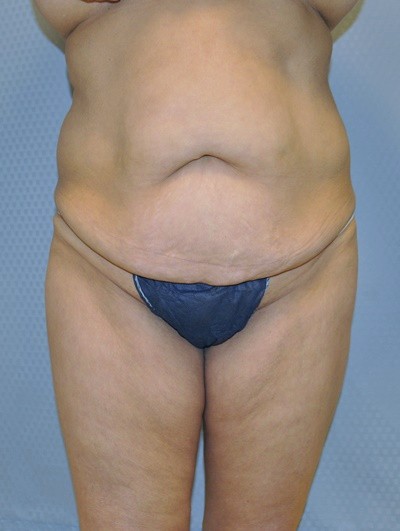 tummy-tuck-plastic-surgery-abdominoplasty-loose-skin-redlands-woman-before-front-dr-maan-kattash