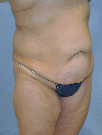 tummy-tuck-plastic-surgery-abdominoplasty-loose-skin-redlands-woman-before-oblique-dr-maan-kattash