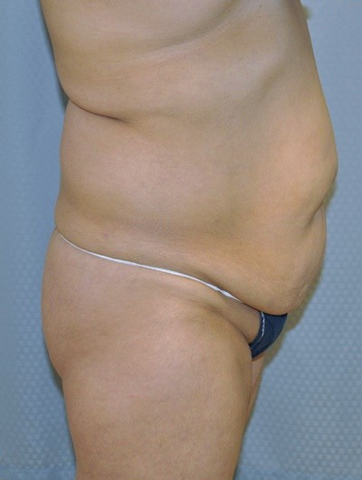 tummy-tuck-plastic-surgery-abdominoplasty-loose-skin-redlands-woman-before-side-dr-maan-kattash