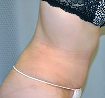 tummy-tuck-plastic-surgery-abdominoplasty-loose-skin-upland-after-side-dr-maan-kattash