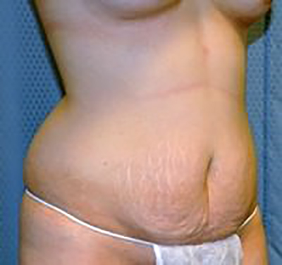 tummy-tuck-plastic-surgery-abdominoplasty-loose-skin-upland-woman-before-front-dr-maan-kattash