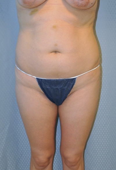 Before liposuction