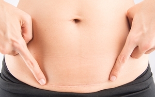 recovery from tummy tuck surgery is easier than C-section