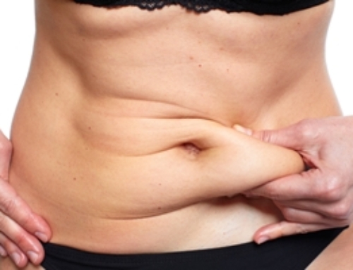 Who is a Good Candidate for Tummy Tuck?